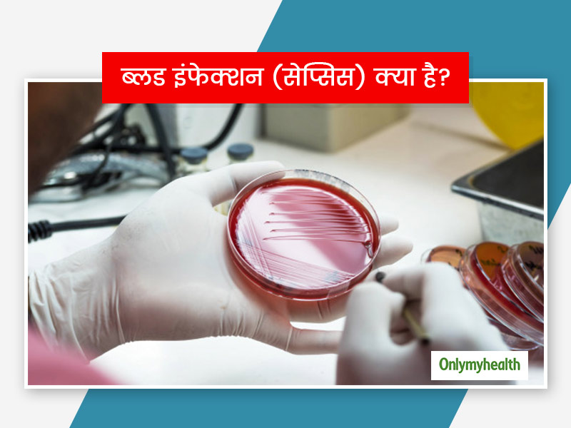 ब्लड इंफेक्शन ( सेप्सिस ) क्या है ? जानें कारण, लक्षण और बचाव